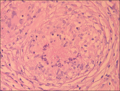 Well-defined granuloma with central necrosis.